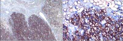 Immunohistological Staining of Carbonic Anhydrase IX/CA9 in Renal Carcinoma Tissue